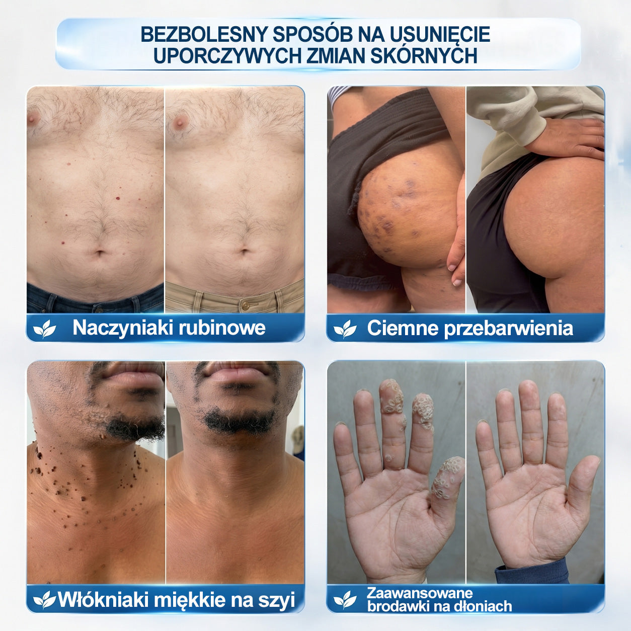 Oficjalny sklep markowy |💖Hiskin® 7 𝑫𝒏𝒊 𝑷𝒓𝒆𝒑𝒂𝒓𝒂𝒕 𝑫𝒐 𝑼𝒔𝒖𝒘𝒂𝒏𝒊𝒂 𝑾łó𝒌𝒏𝒊𝒂𝒌ó𝒘 𝑴𝒊ę𝒌𝒌𝒊𝒄𝒉 𝑰 𝑷𝒓𝒛𝒆𝒃𝒂𝒓𝒘𝒊𝒆ń(𝐁𝐞𝐳 𝐁ó𝐥𝐮, 𝐁𝐞𝐳 𝐁𝐥𝐢𝐳𝐧 – 𝐑𝐨𝐥𝐥-𝐨𝐧)